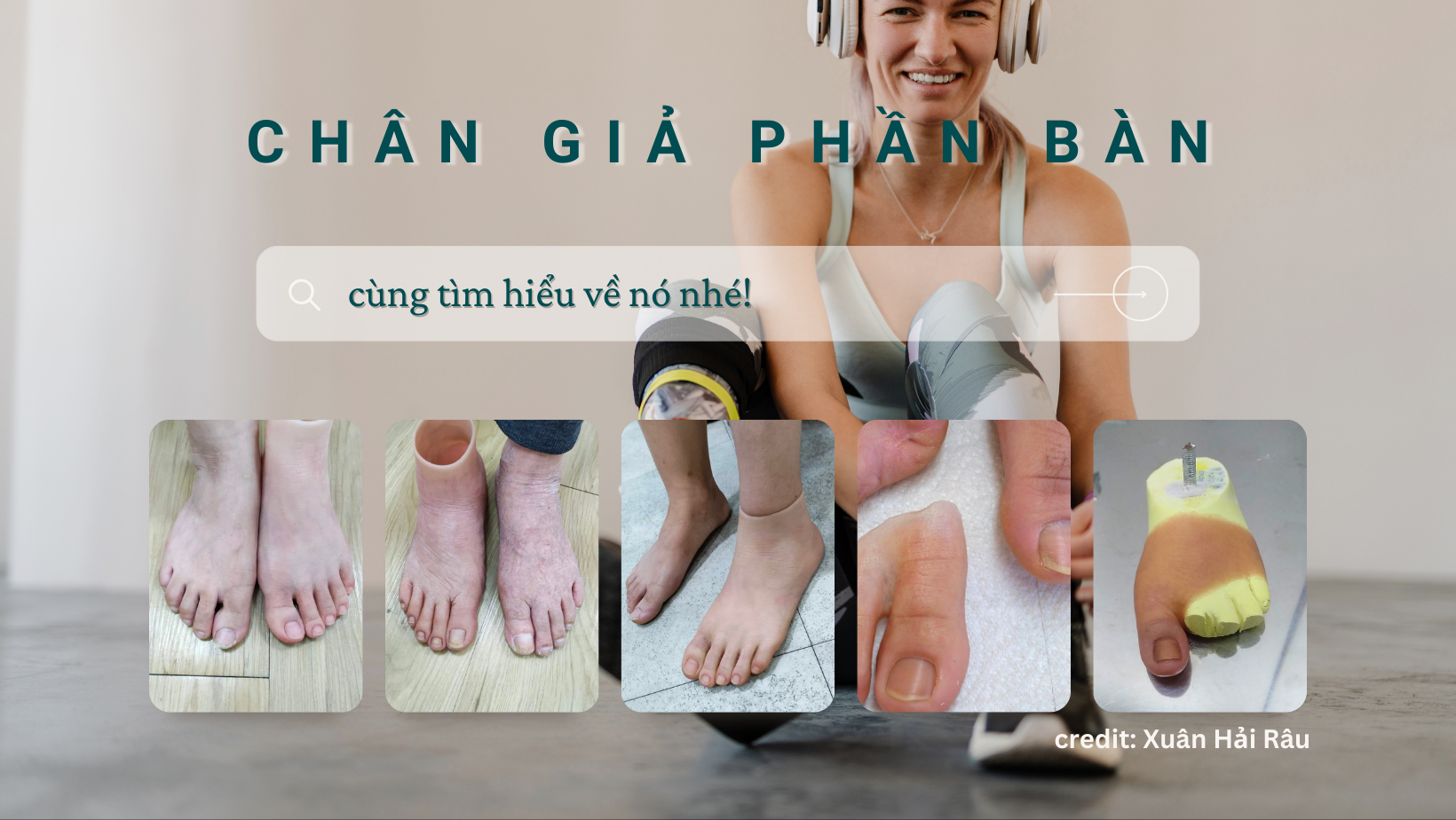 Chân giả phần bàn