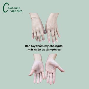 Chị Lâm (An Giang) mất ngón tay út và
tay cái do tai nạn lao động