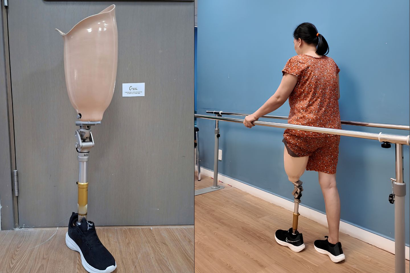 Chân Giả Trên Gối Bao Nhiêu Tiền