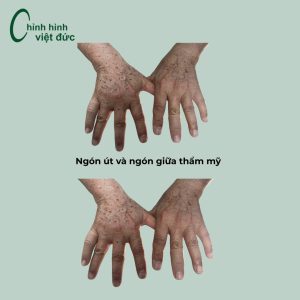 Chú Giang (Úc) mất ngón tay út và ngón
giữa do tai nạn lao động