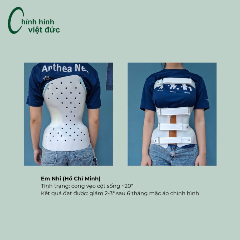 áo chỉnh cong vẹo cột sống