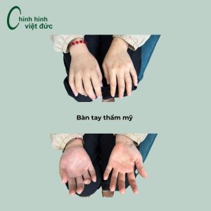 Chị Tâm (Lâm Đồng) mất bàn tay do tai
nạn lao động