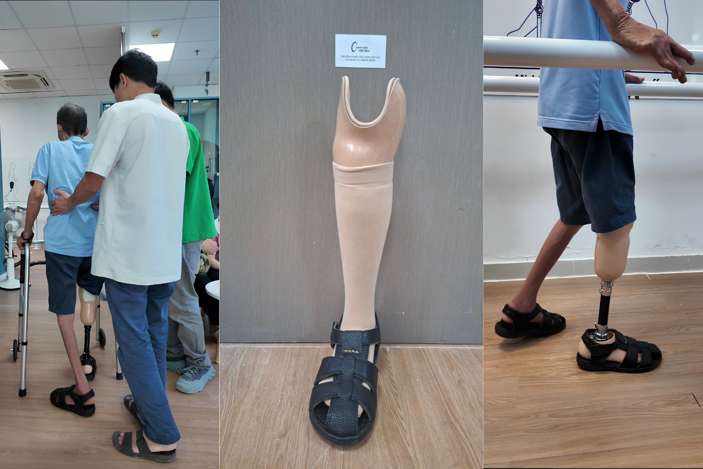 căn chỉnh chân giả chú chú bị cong vẹo cột sống