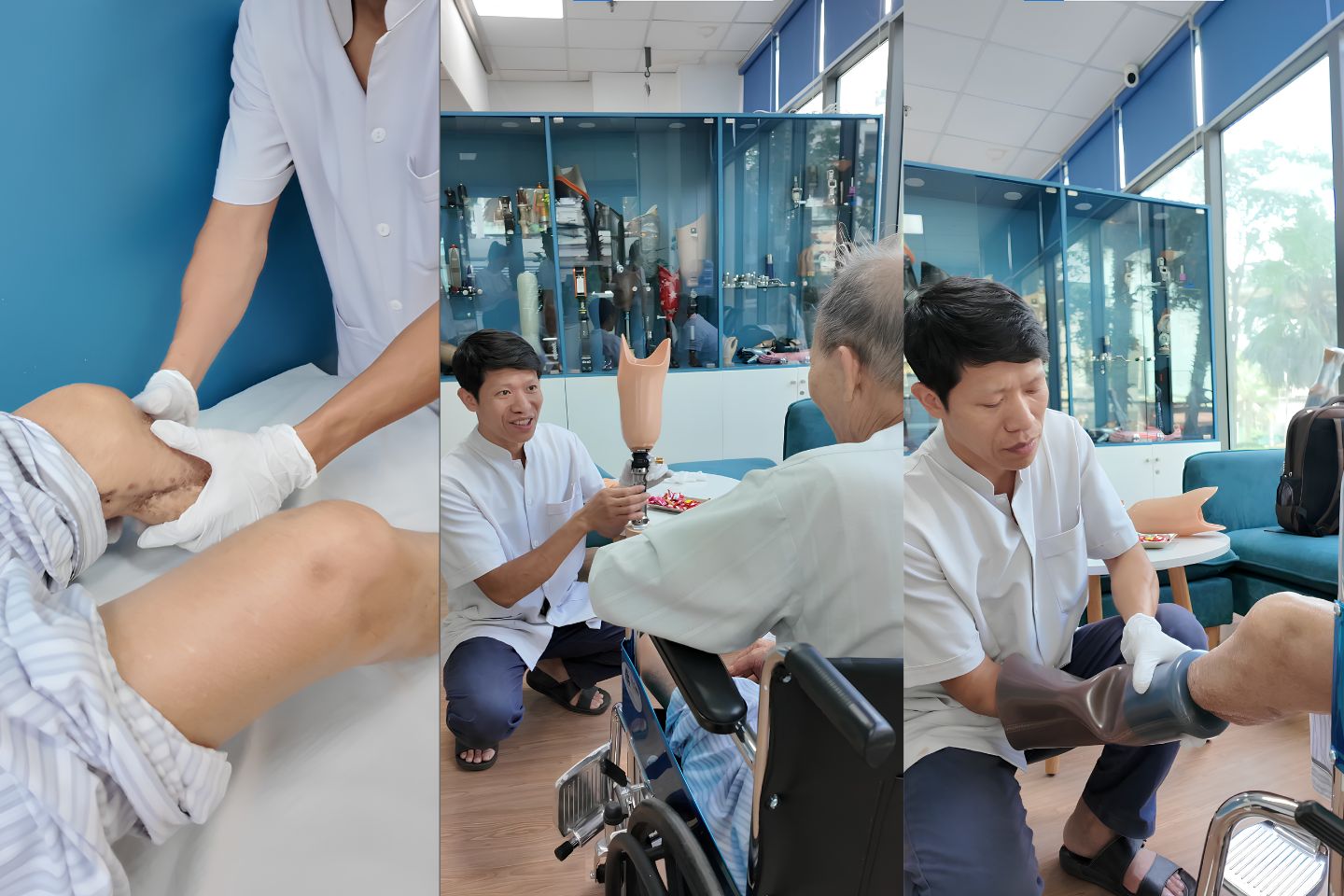 chăm sóc mỏm cụt chi dưới