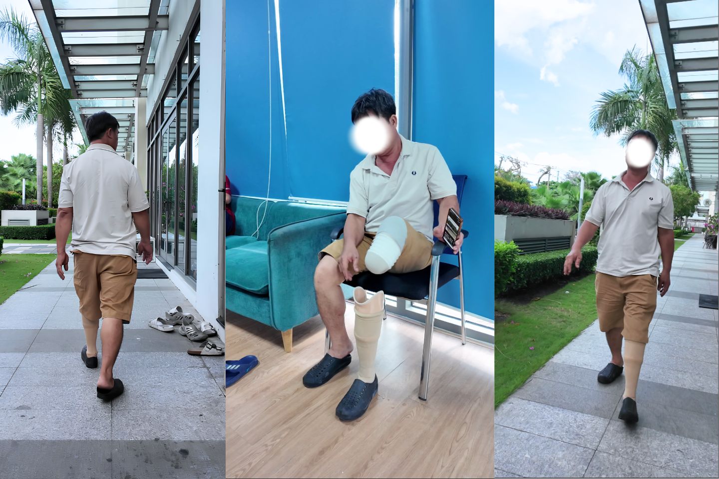 chân giả làm đau lưng