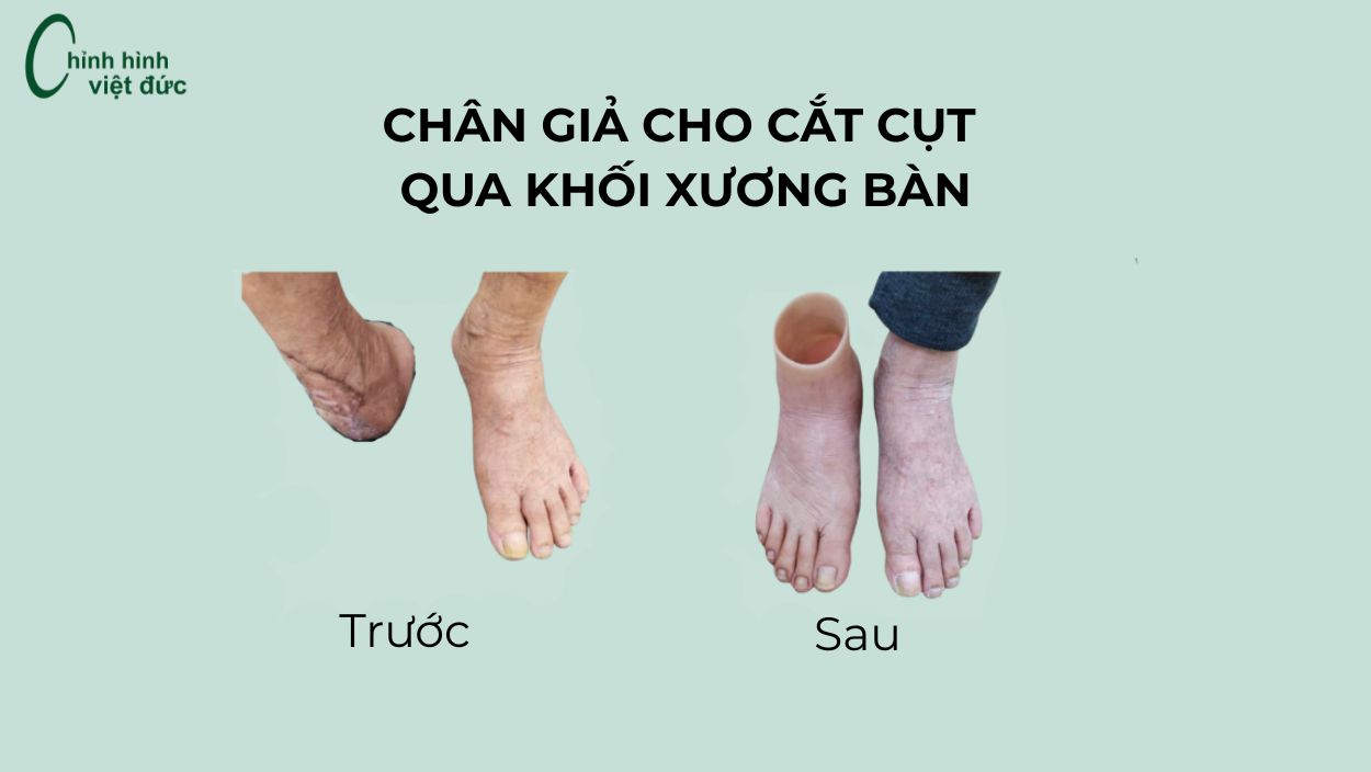 chân giả