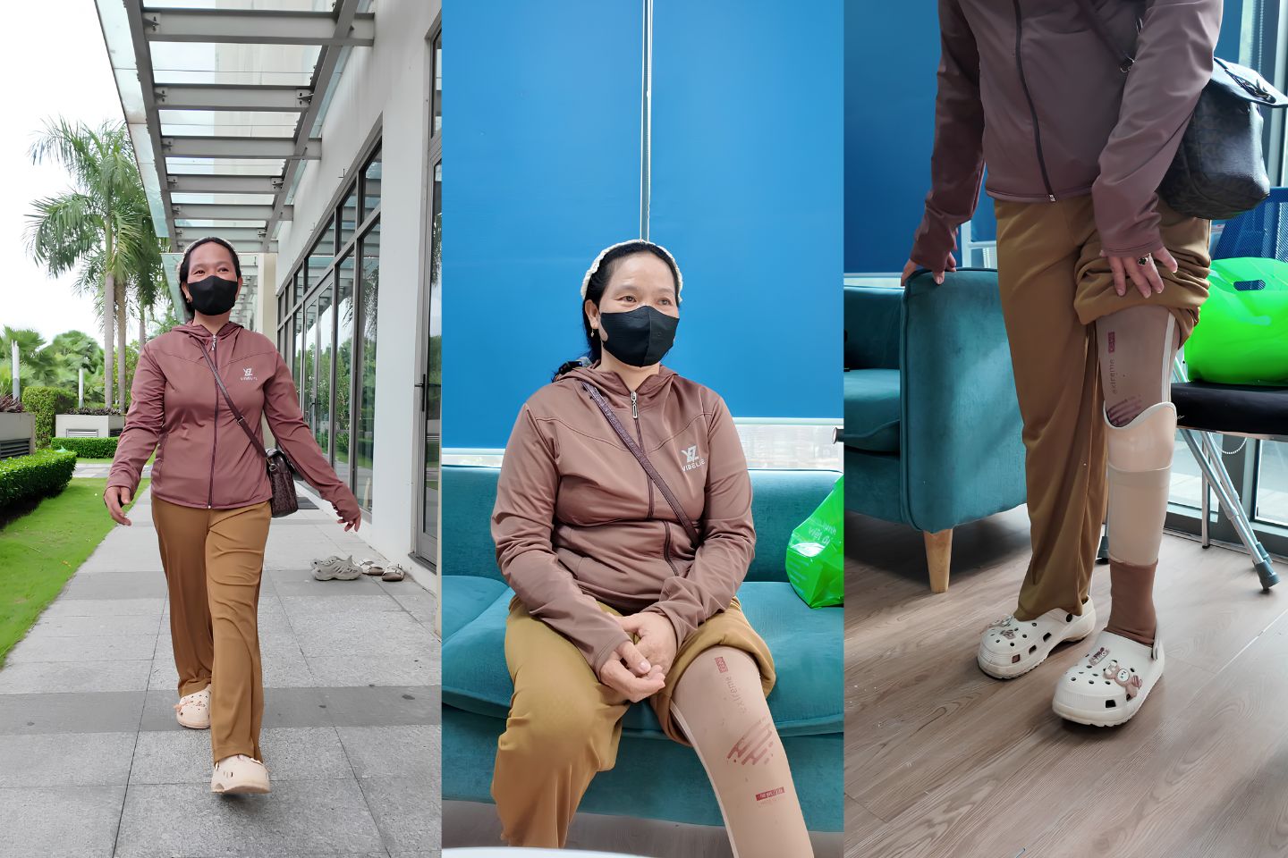 chị Hạnh đã từng sợ đi chân giả