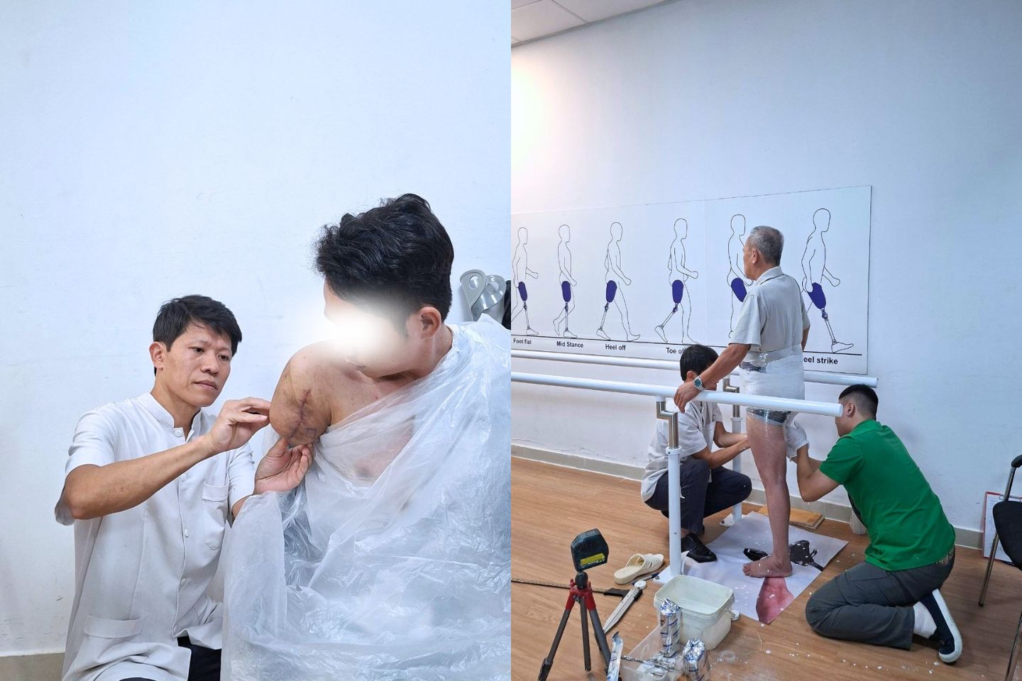 kỹ thuật lắp tay chân giả