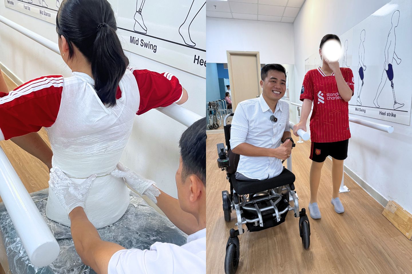 lắp 2 chân giả tháo khớp hông
