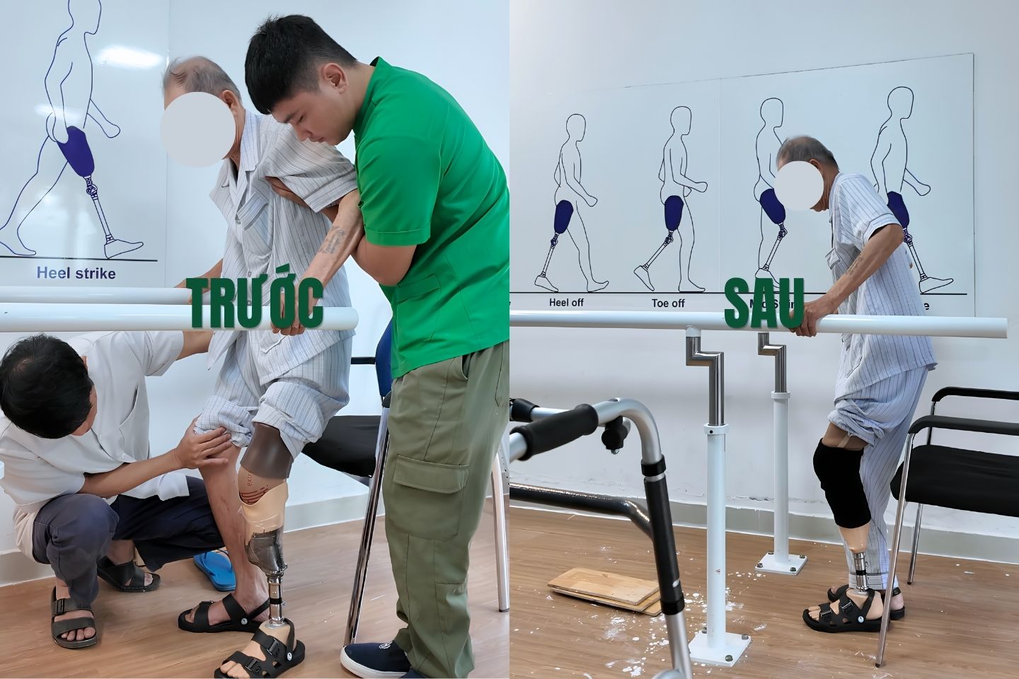 lắp chân giả cho ông cụ ở Bình Định