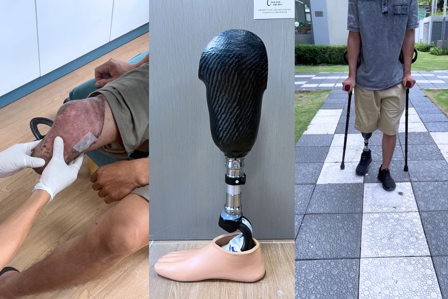 lắp chân giả dưới gối cho anh Hòa