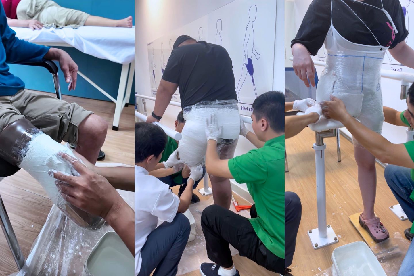 lấy khuôn lắp chân giả