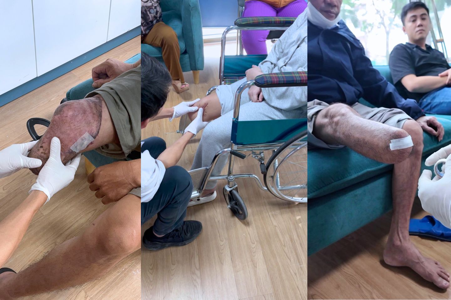 mỏm cụt chân dưới gối