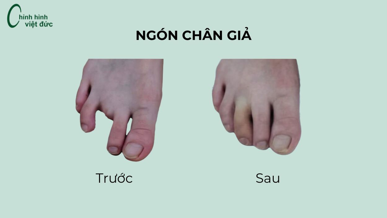 chân giả