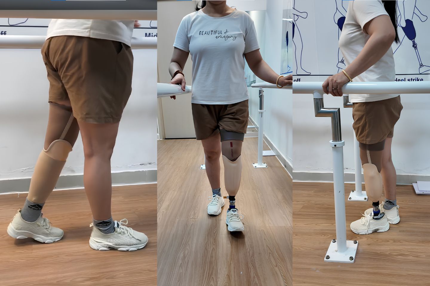 tập đi chân giả dưới gối ngày đầu tiên