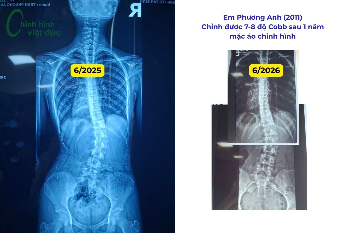 áo chỉnh cong vẹo cột sống
