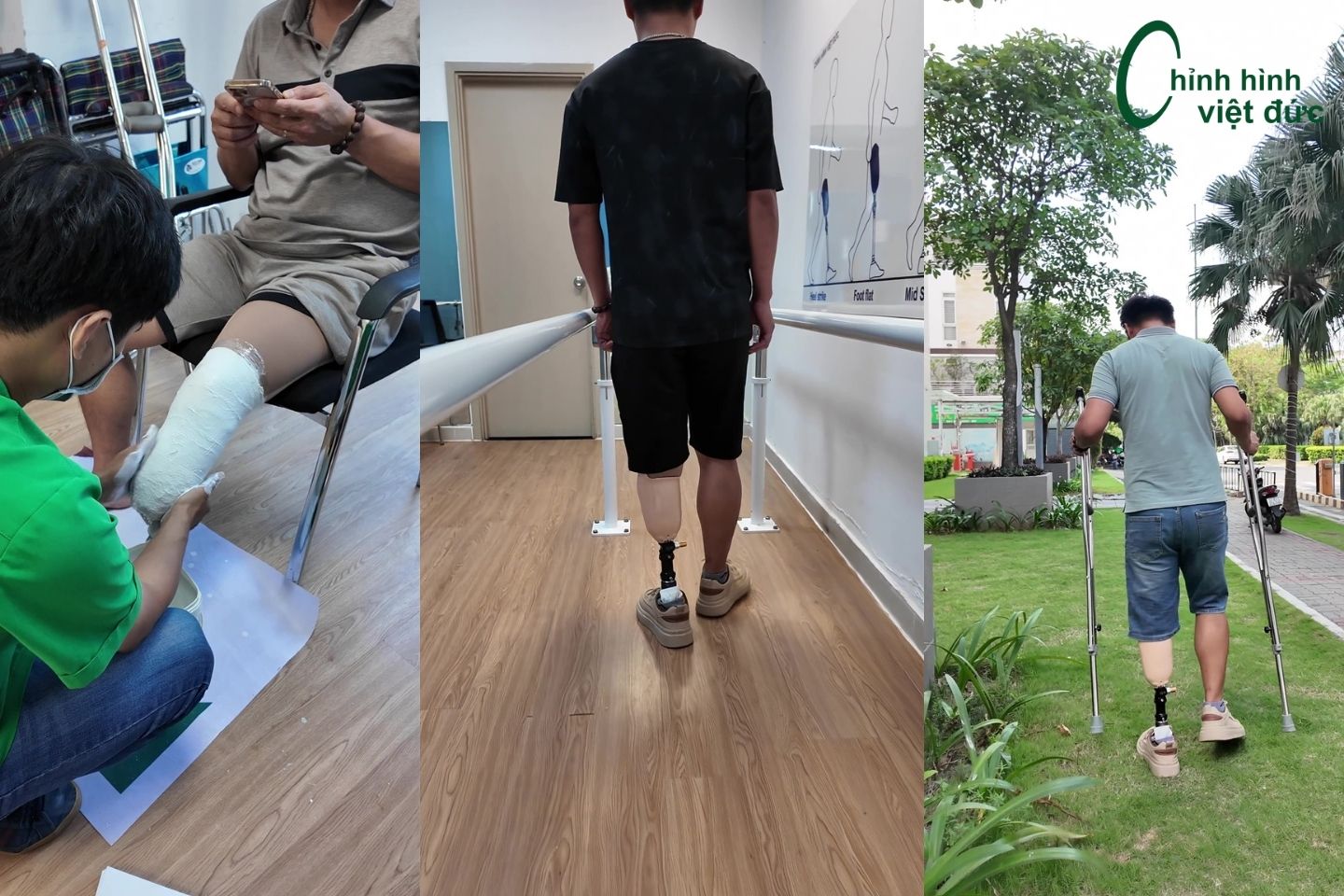 hoàn thiện chân giả dưới gối cho anh Thành