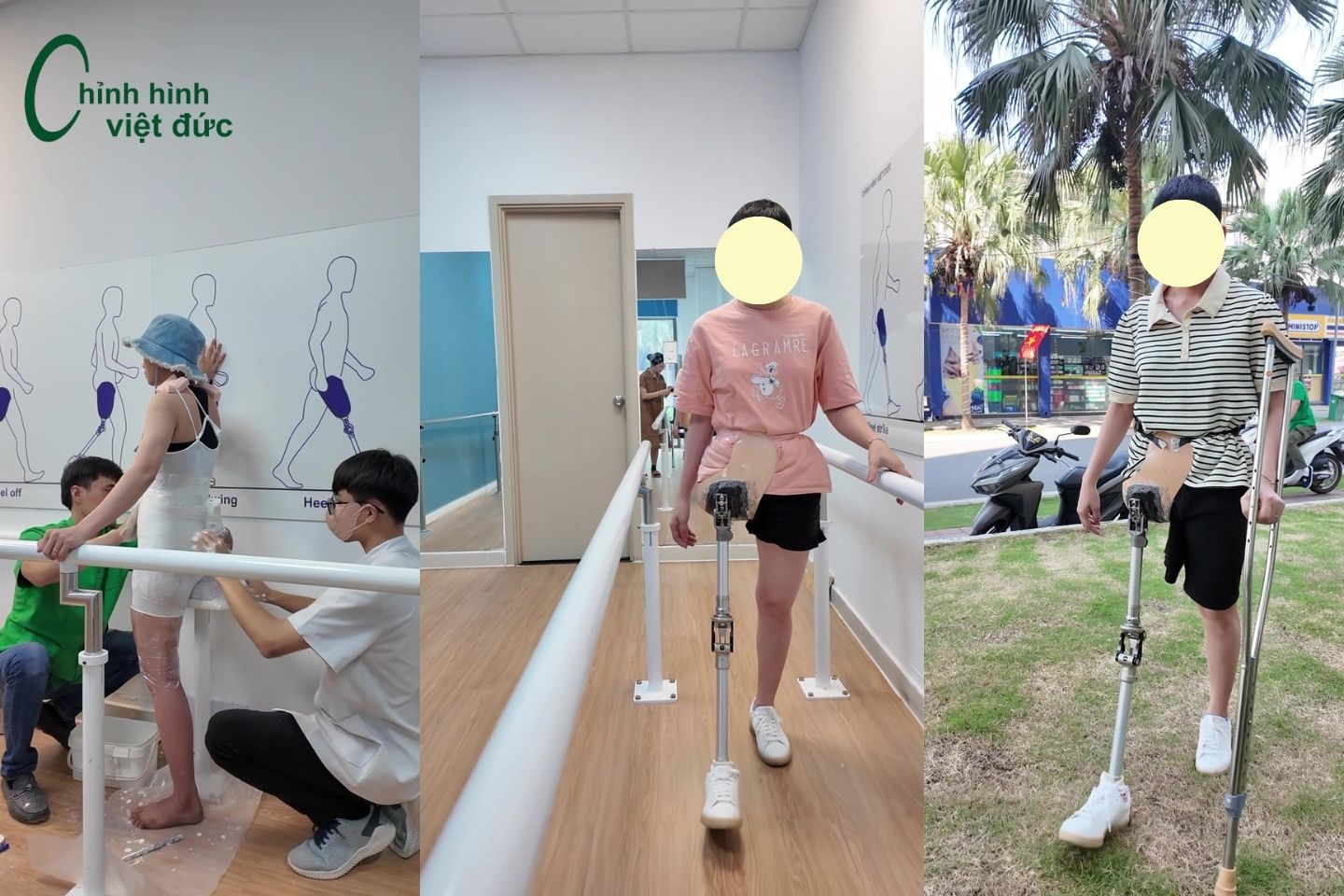 lắp chân giả tháo khớp hông cho chị Đoan