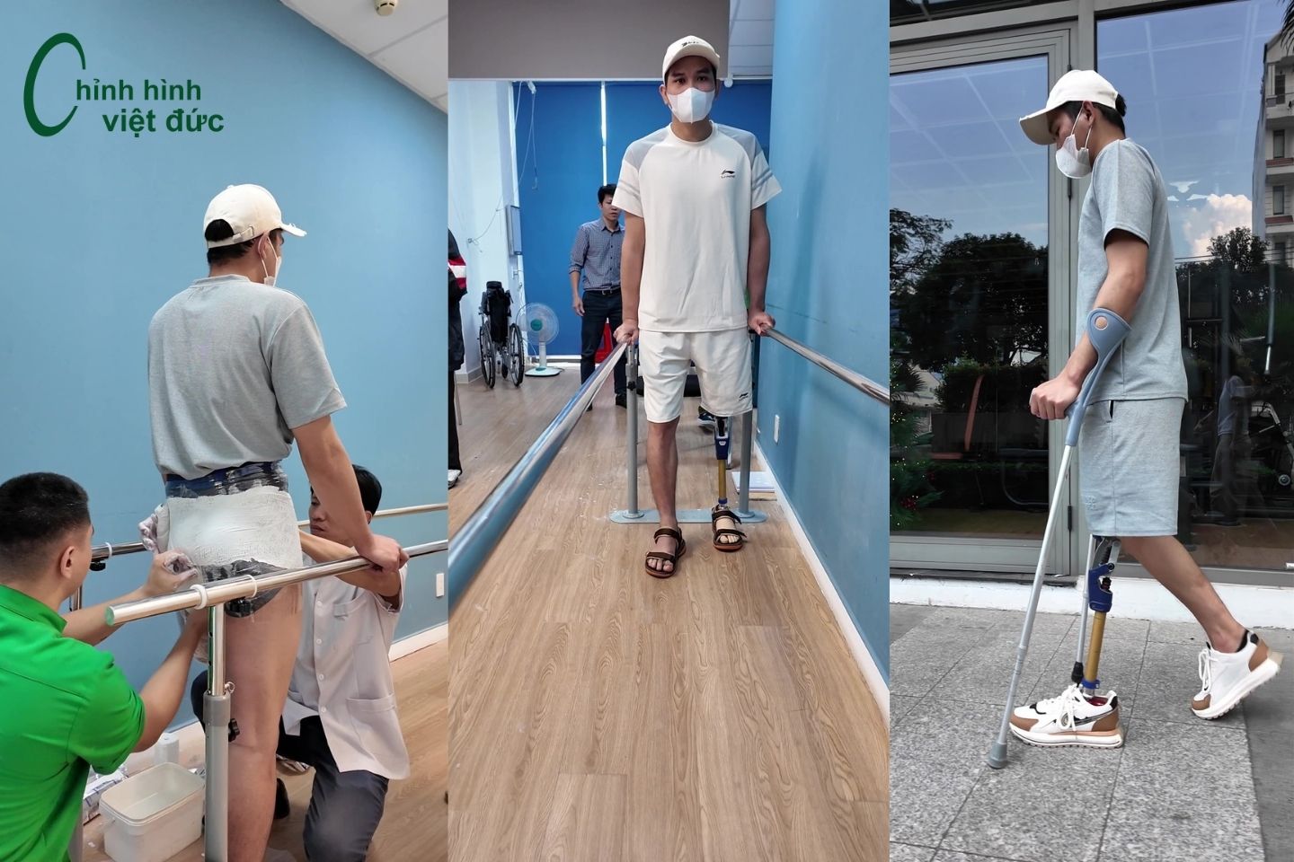 hoàn thiện chân giả trên gối cho anh Khiêm