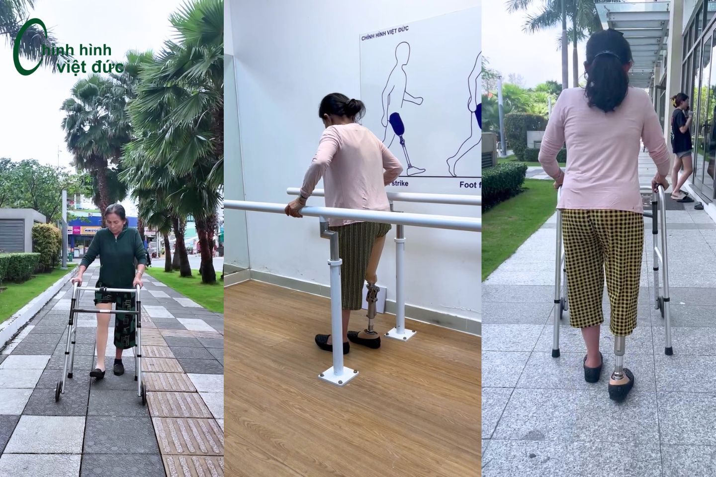 tập đi chân giả trên gối tập đi chân giả trên gối