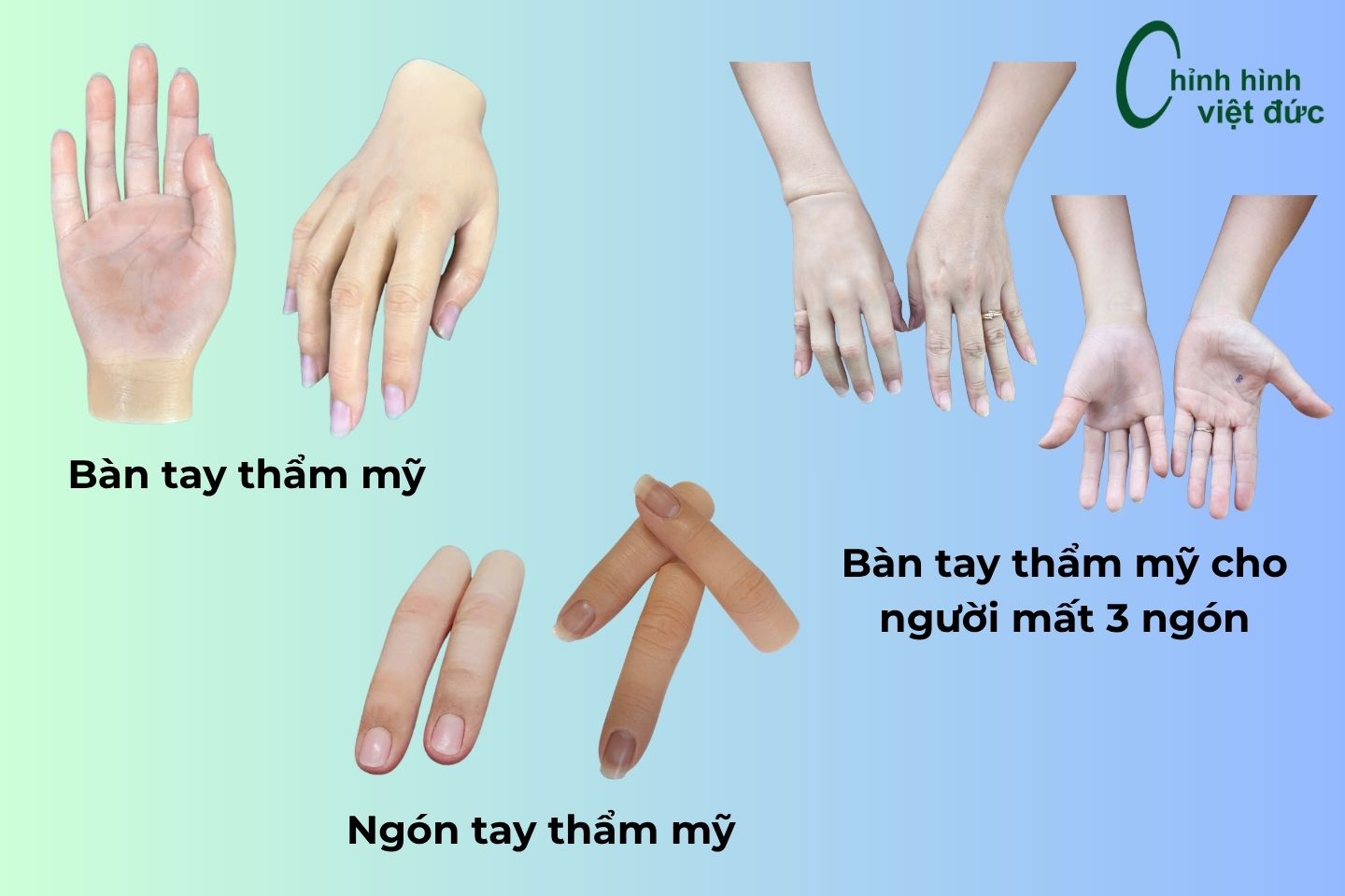 tay giả thẩm mỹ