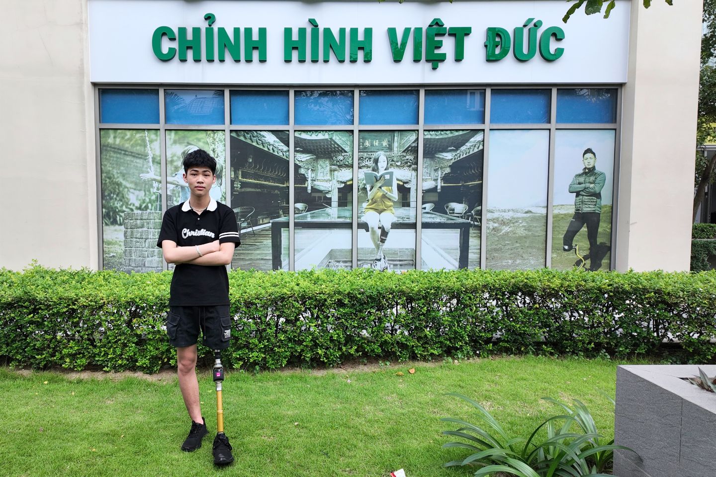 lắp chân giả trên gối chất lượng