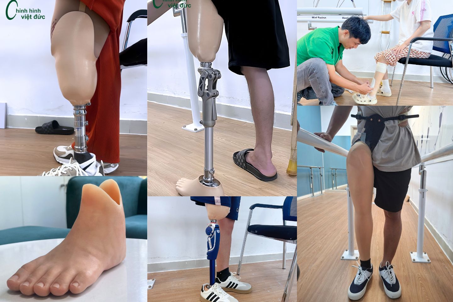 chân giả cho cắt cụt chi dưới