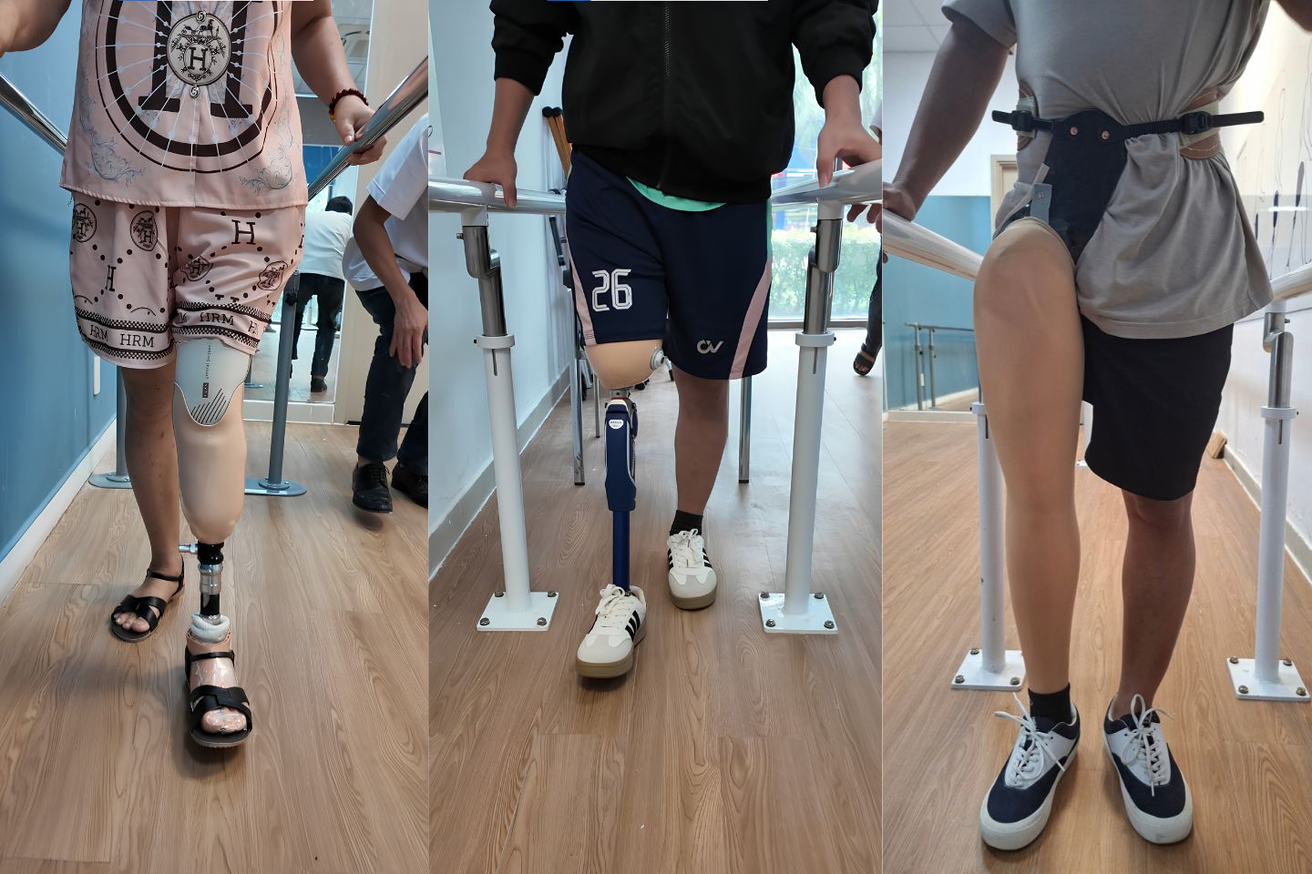 người cụt 1 chân có đi lại bình thường được không